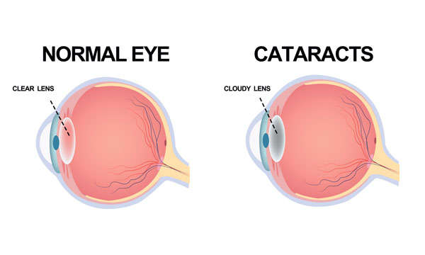 cataracts is a common eye condition in mississauga
