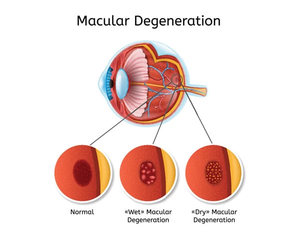 macular degeneration is a common eye condition in mississauga